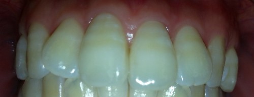 ホワイトニングで、自然に健康的な白い歯になれました！