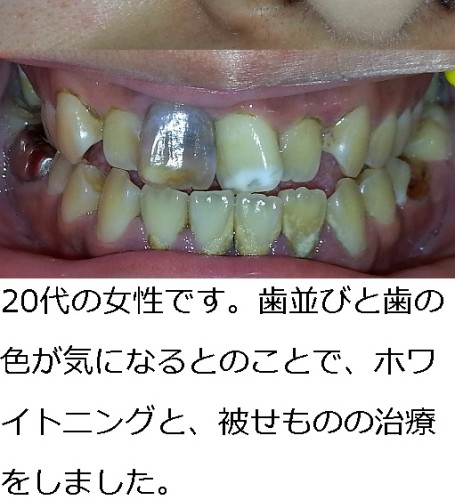 汚かった歯がホワイトニングと虫歯治療で見違えるようにきれいに！！