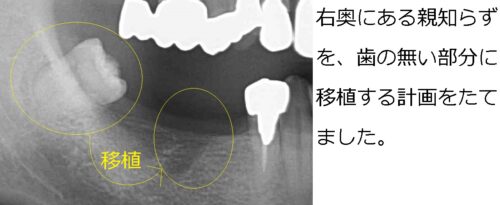 移植計画