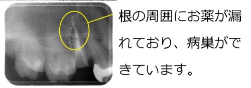 割れて痛みがあった歯が意図的再植で完全に治癒！