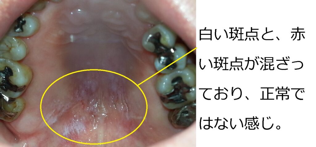 早期のお口の中のガンを発見していただき、命拾いを。 | もろとみ歯科