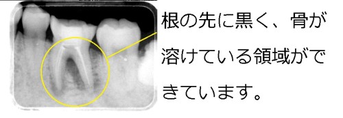 抜歯しかないと言われた歯を、意図的再植で治療！