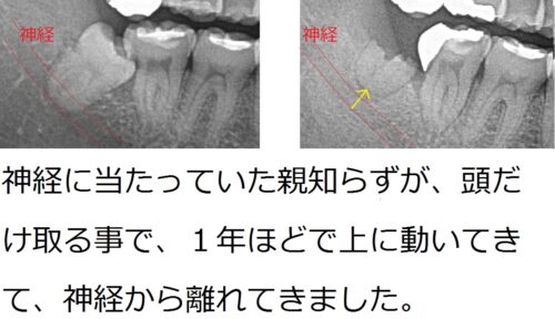 親知らず浮き上がり