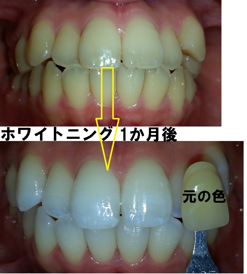 ホワイトニング後1ヶ月で、見違える様にきれいに！ | もろとみ歯科