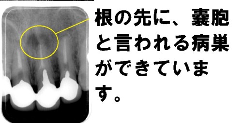 再発を繰り返す根尖病巣に歯根端切除と骨移植で治療１