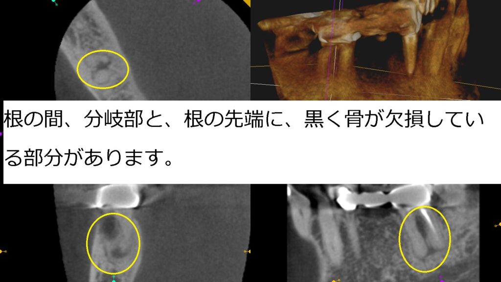 歯周病で失った骨を人工骨移植で再生!! | もろとみ歯科