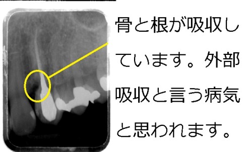 原因不明と言われていた腫れが歯周外科治療で治癒