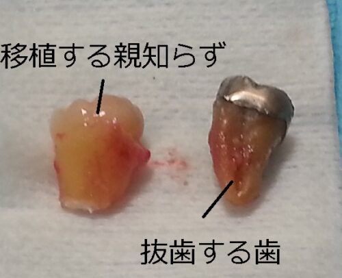 歯の移植２