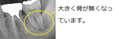 早良区　城南区　もろとみ歯科　歯周病　根尖病巣 (1)