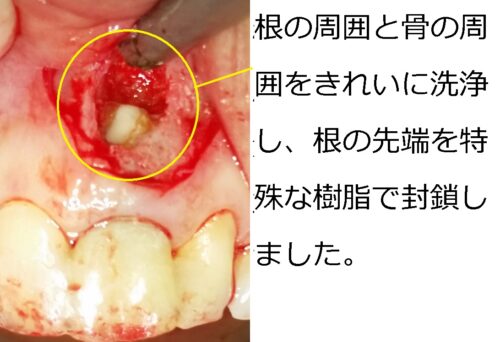 早良区　城南区　もろとみ歯科　歯周病　歯根嚢胞　歯根端切除 (4)