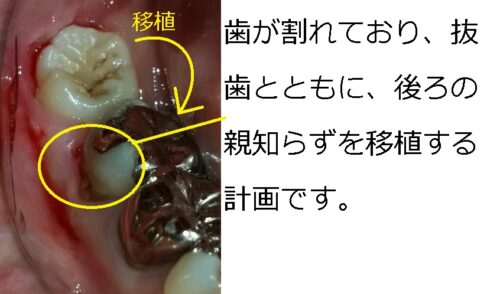 早良区　城南区　もろとみ歯科　移植　歯周病　根尖病巣　歯根嚢胞 (2)