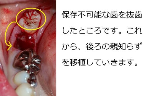 早良区　城南区　もろとみ歯科　移植　歯周病　根尖病巣　歯根嚢胞 (4)