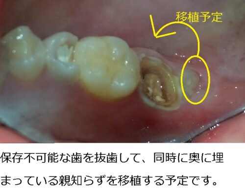 早良区　城南区　もろとみ歯科　歯周病　移植　根尖病巣　歯根嚢胞　予防 (3)