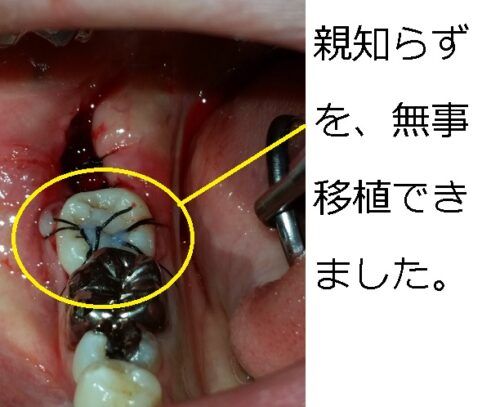 早良区　城南区　もろとみ歯科　移植　歯周病　根尖病巣　歯根嚢胞 (6)