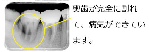 早良区　城南区　もろとみ歯科　移植　歯周病　根尖病巣　歯根嚢胞 (1)