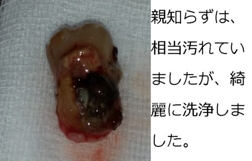 歯根はせつ　歯の移植　親知らず　もろとみ歯科 (1)