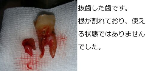 歯根はせつ　歯の移植　親知らず　もろとみ歯科 (3)