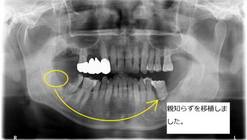 歯根はせつ　歯の移植　親知らず　もろとみ歯科 (5)