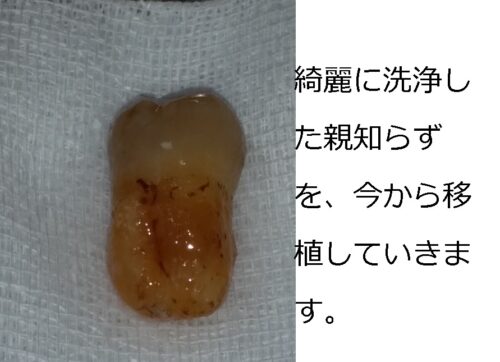 歯根はせつ　歯の移植　親知らず　もろとみ歯科 (2)