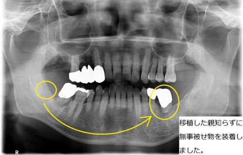 歯根はせつ　歯の移植　親知らず　もろとみ歯科 (8)