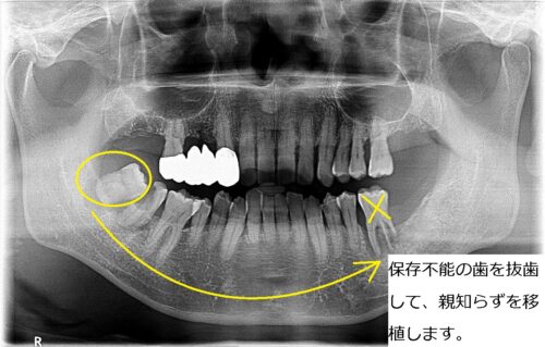 歯根はせつ　歯の移植　親知らず　もろとみ歯科 (4)