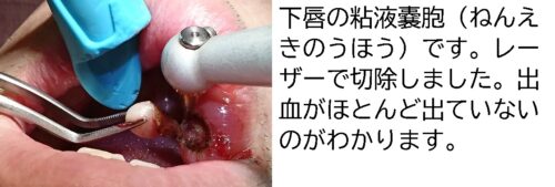 1 レーザー　唇　のうほう　のう胞　嚢胞　痛くない　上手　安心　安全　口腔外科 (2)