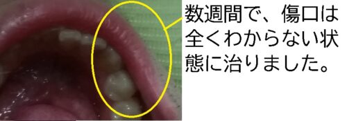 3 レーザー　唇　のうほう　のう胞　嚢胞　痛くない　上手　安心　安全　口腔外科 (1)
